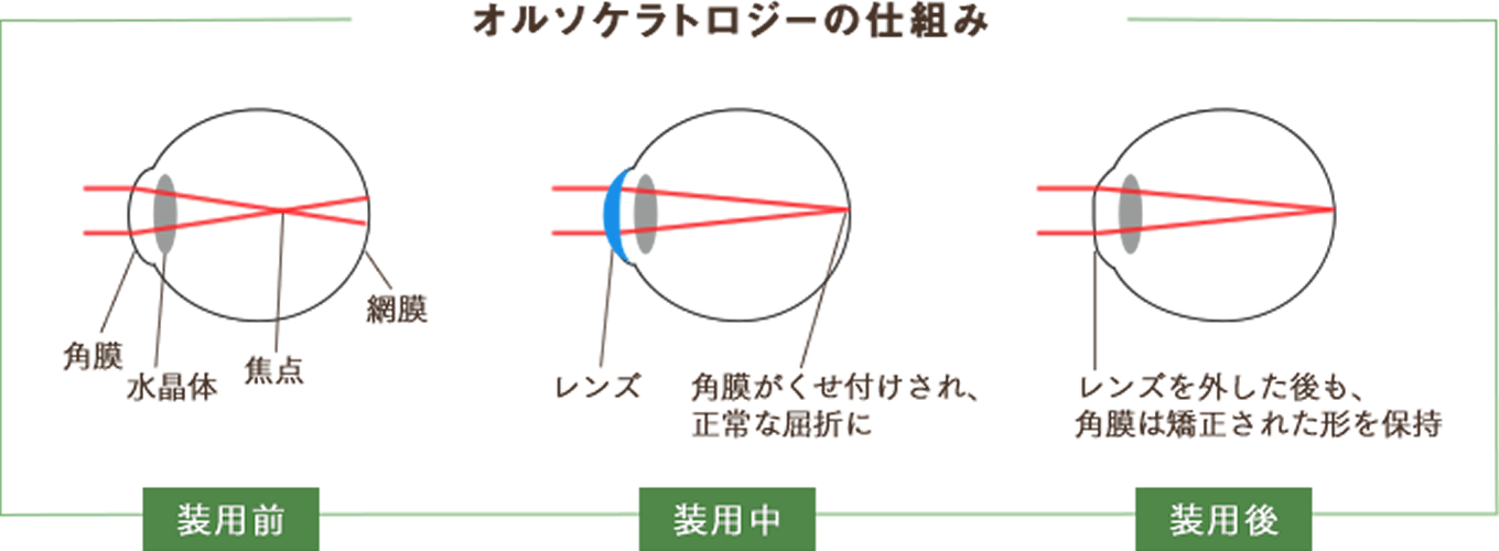 オルソケラトロジーの仕組み　レンズを装用すると角膜がくせ付けされ、正常な屈折に　レンズを外した後も、角膜は矯正された形を保持